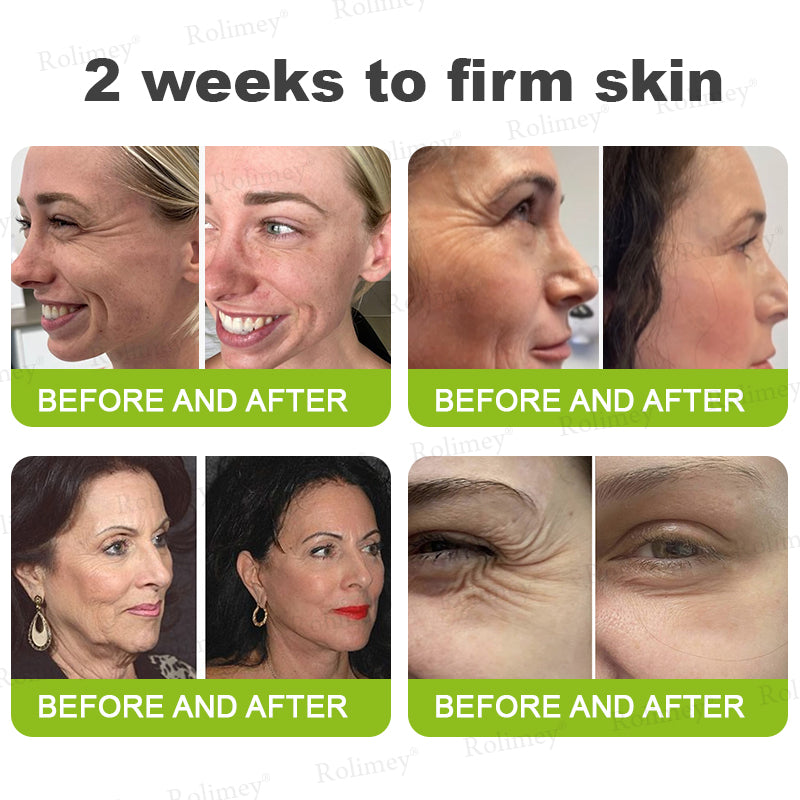 💍🎁Made and shipped from Canada 💫Rolimey® Botox & Vita-A Retinol Shot Wrinkle-Lift Tightening cream - Last Day Promotion 70% OFF