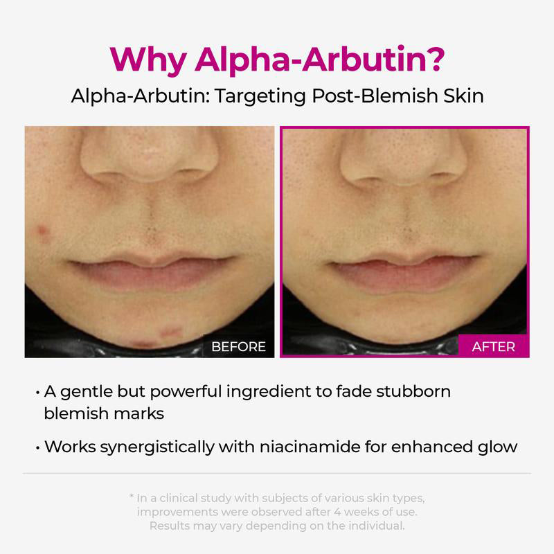 🌷Glass Skin Kit – Fade Blemishes & Shrink Pores Fast | 50% OFF Today Only
