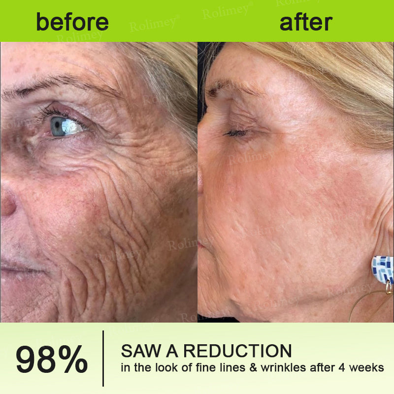 💍🎁Made and shipped from Canada 💫Rolimey® Botox & Vita-A Retinol Shot Wrinkle-Lift Tightening cream - Last Day Promotion 70% OFF