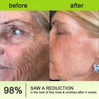 💍🎁Made and shipped from Canada 💫Rolimey® Botox & Vita-A Retinol Shot Wrinkle-Lift Tightening cream - Last Day Promotion 70% OFF