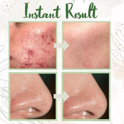 🌼50% OFF🌿 Holy Basil Bubble Deep Mask — 13% Herbal Power for Clear & Fresh Skin